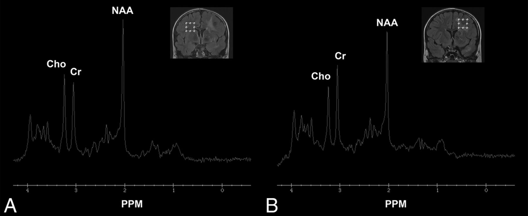 Madusamy Sax Video - Brain Abnormalities and Epilepsy in Patients with Parry-Romberg Syndrome |  American Journal of Neuroradiology