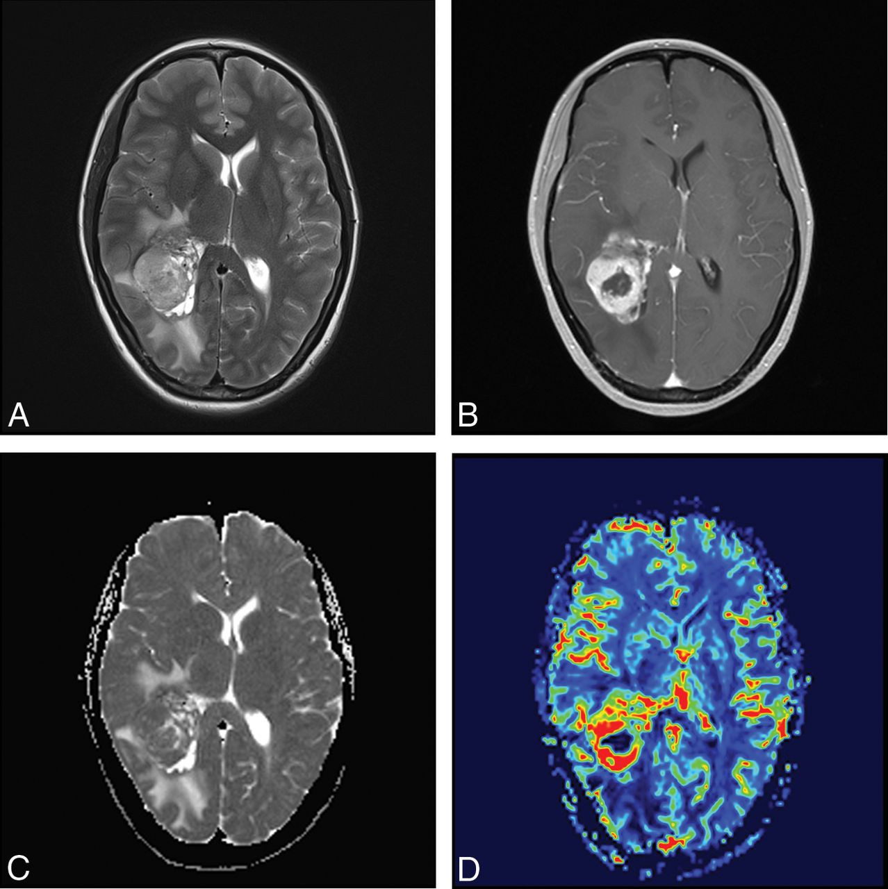 MR Imaging Features of Anaplastic Pleomorphic