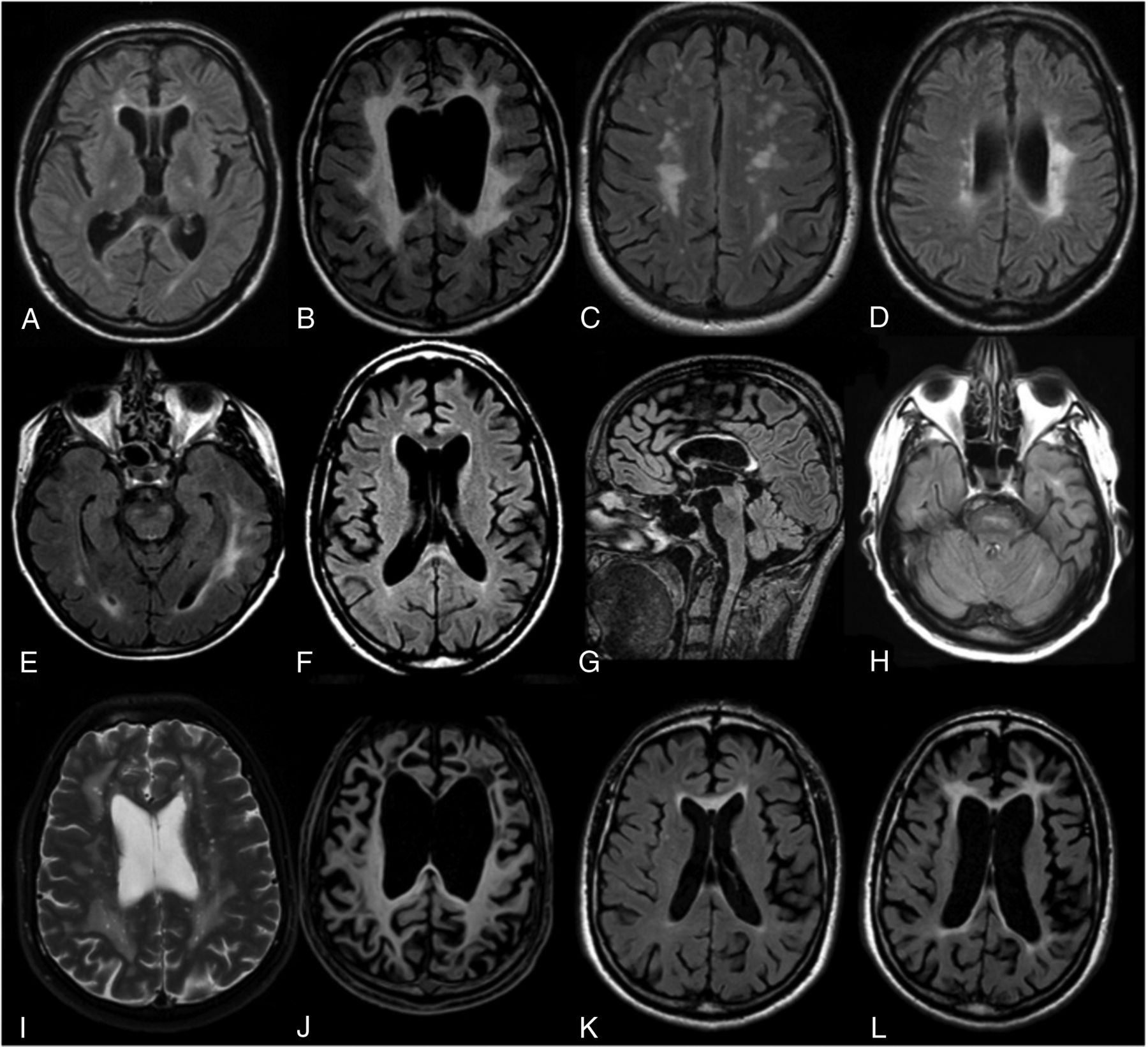 Adult-Onset Leukoencephalopathy with Axonal Spheroids and Pigmented ...