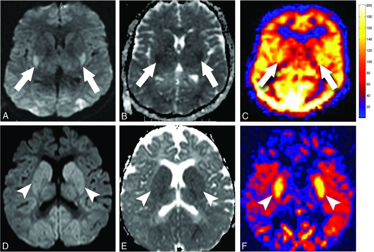 Anoxic Brain Injury Detection with the Normalized Diffusion to ASL
