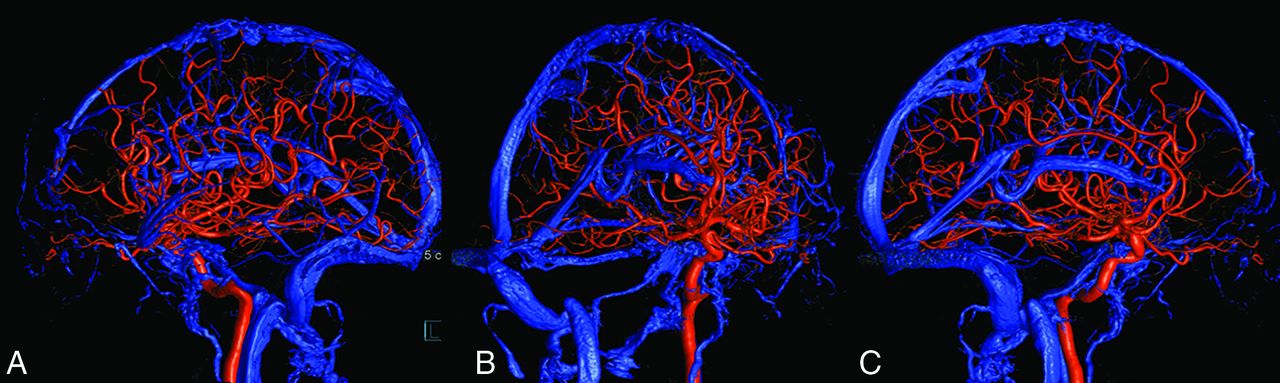 Arterial and Venous 3D Fusion AV-3D-DSA: A Novel Approach to  Cerebrovascular Neuroimaging | American Journal of Neuroradiology