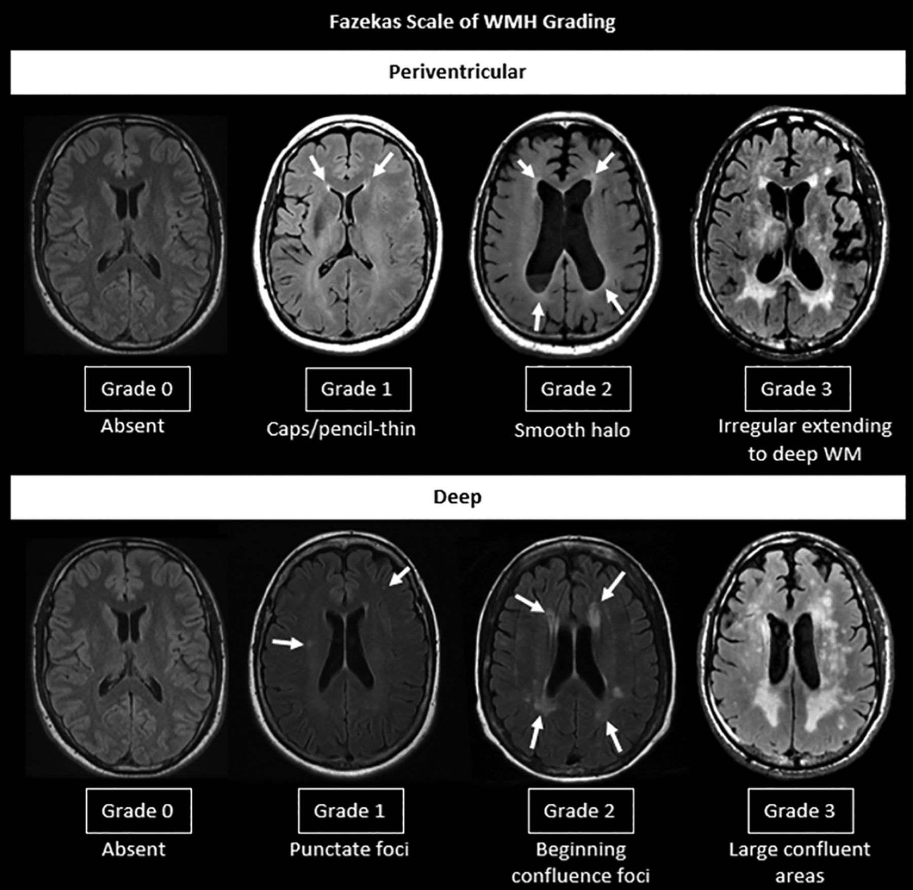 Small Vessel Disease, a Marker of Brain Health: What the Radiologist ...