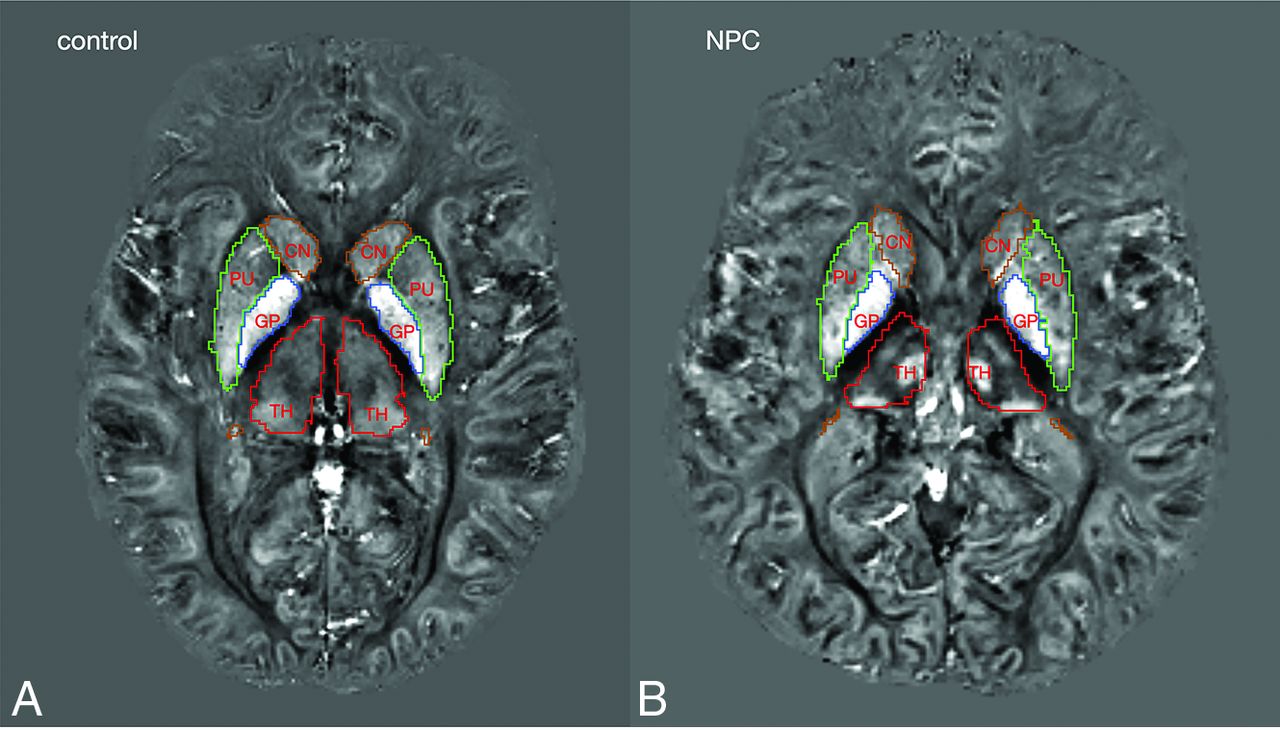 White and gray matter alterations in adults with Niemann-Pick