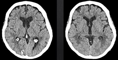 February 5, 2019 - Case of the Month | American Journal of Neuroradiology