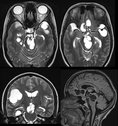 November 2021 - Case of the Month | American Journal of Neuroradiology